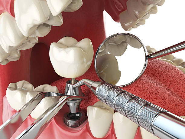 Best Emergency Root Canal Treatment in Bayou Cane, LA